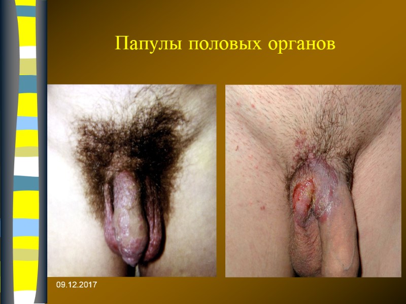 09.12.2017 Папулы половых органов